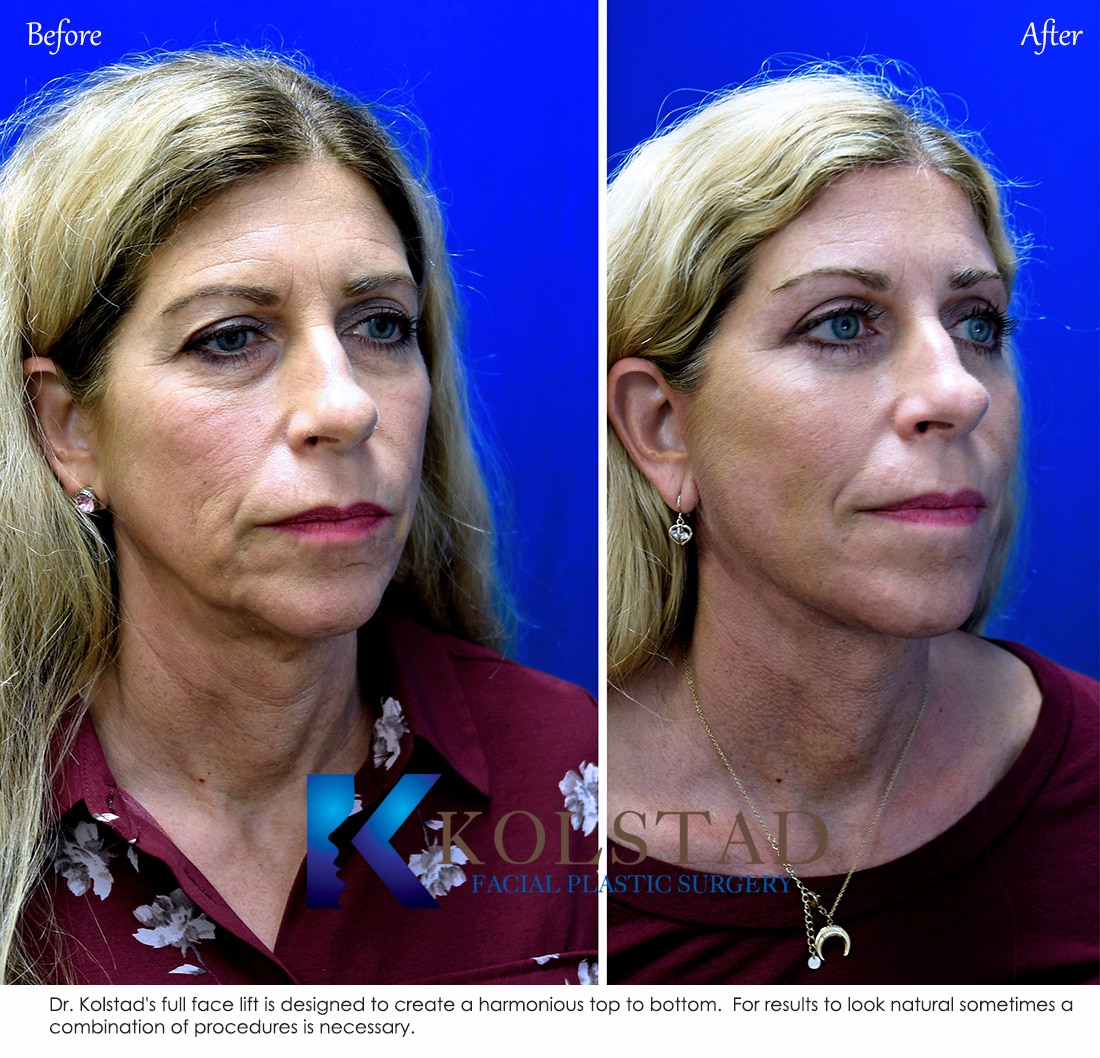 How to Achieve Natural Facelift Results - Los Angeles, CA