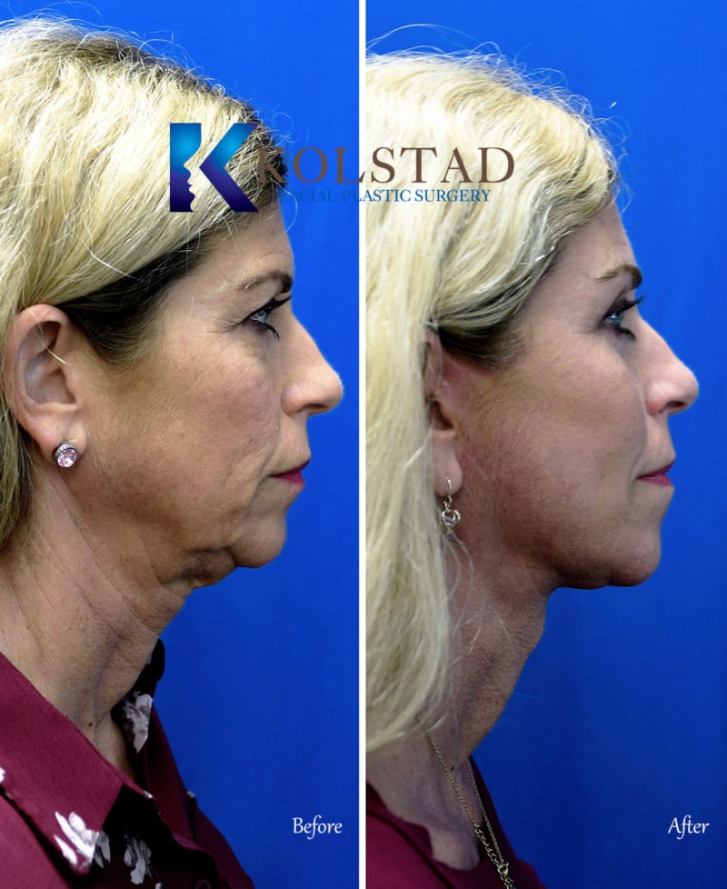 San Diego Full Facelift Results 3 Dr. Kolstad San Diego Facial
