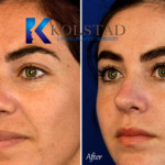 before and after rhinoplasty san diego