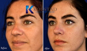 before and after rhinoplasty san diego
