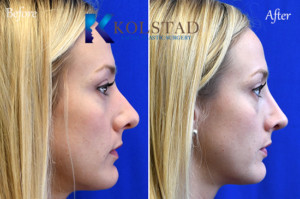 womans best revision rhinoplasty san diego