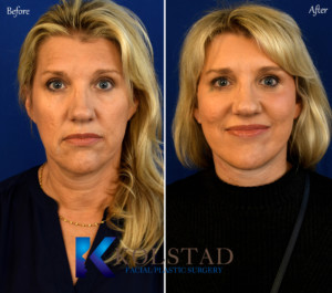 natural face lift before and after