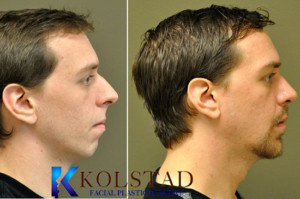 nose job san diego