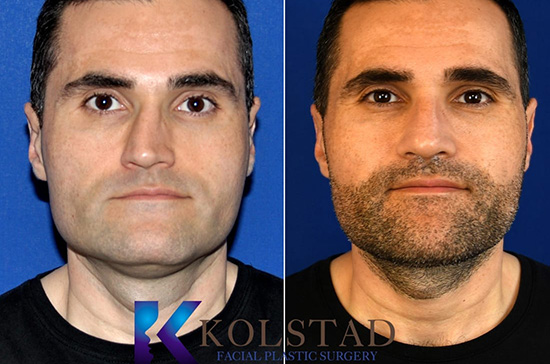 male rhinoplasty results for a crooked bridge