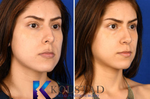 ethnic rhinoplasty san diego