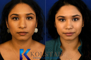 hispanic rhinoplasty san diego