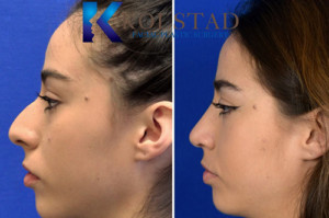 mexican rhinoplasty san diego