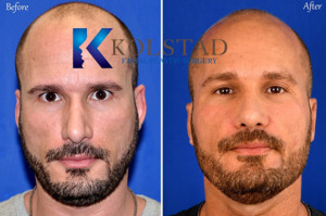 male rhinoplasty results for revision nose job