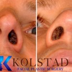 rhinoplasty san diego