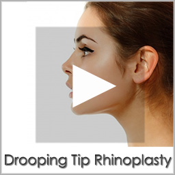 drooping tip rhinoplasty before after