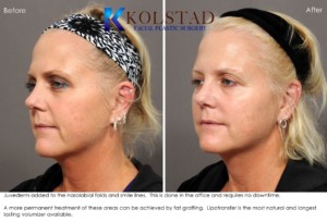 Juvederm Specials San Diego Nasolabial Folds Marionette Lines Natural Results