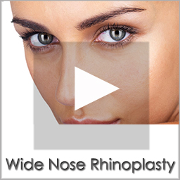 wide nose rhinoplasty before after