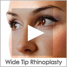 wide tip rhinoplasty before after