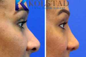 african-american-rhinoplasty-san-diego