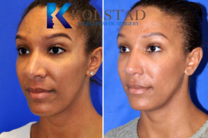 african american rhinoplasty san diego