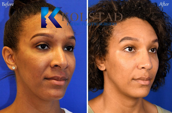 african-american-rhinoplasty-san-diego-106-copy | Dr. Kolstad - San ...