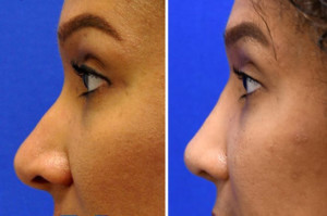 african american rhinoplasty san diego