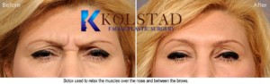 botox and filler best doctor top injector san diego la jolla del mar