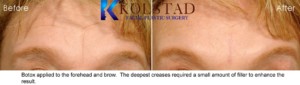 botox and filler forehead wrinkles smooth natural results