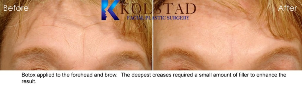 Botox And Filler Forehead Wrinkles Smooth Natural Results San Diego La