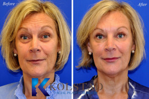 botox browlift forehead wrinkles frown lines san diego del mar la jolla