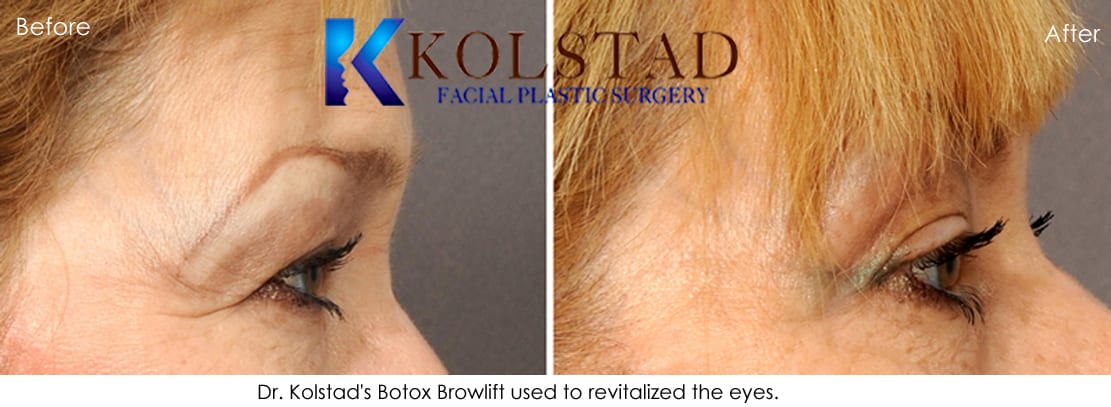 Botox to Treat Crowsfeet Wrinkles | Botox Specialist in La ...