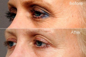 botox crowsfeet smile lines san diego la jolla sd top doctor best injector cost