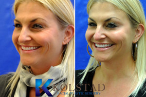 botox crowsfeet wrinkles eyes best doctor la jolla san diego preventative