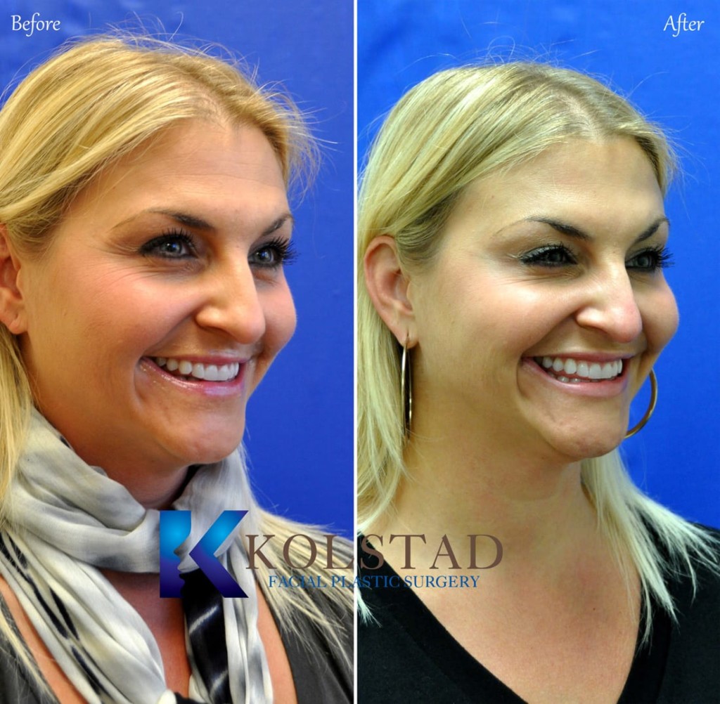 botox-crowsfeet-wrinkles-eyes-preventative-top-injector-san-diego-la ...