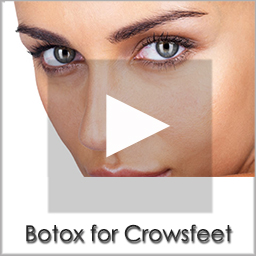 botox crowsfeet