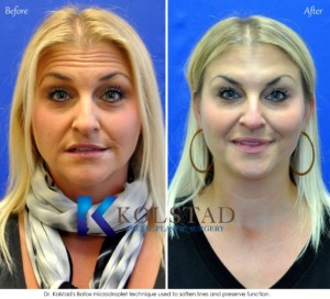 botox expert doctor forehead wrinkles cost specials natural appearance san diego la jolla