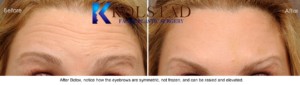 botox forehead wrinkles expert top doctor not frozen