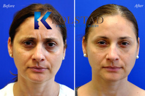 botox glabella 11s filler eyelift antiaging tired la jolla san diego plastic surgeon