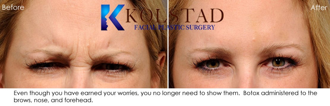 botox-san-diego-la-jolla-glabella-frown-11s-wrinkles-deep-creases | Dr ...