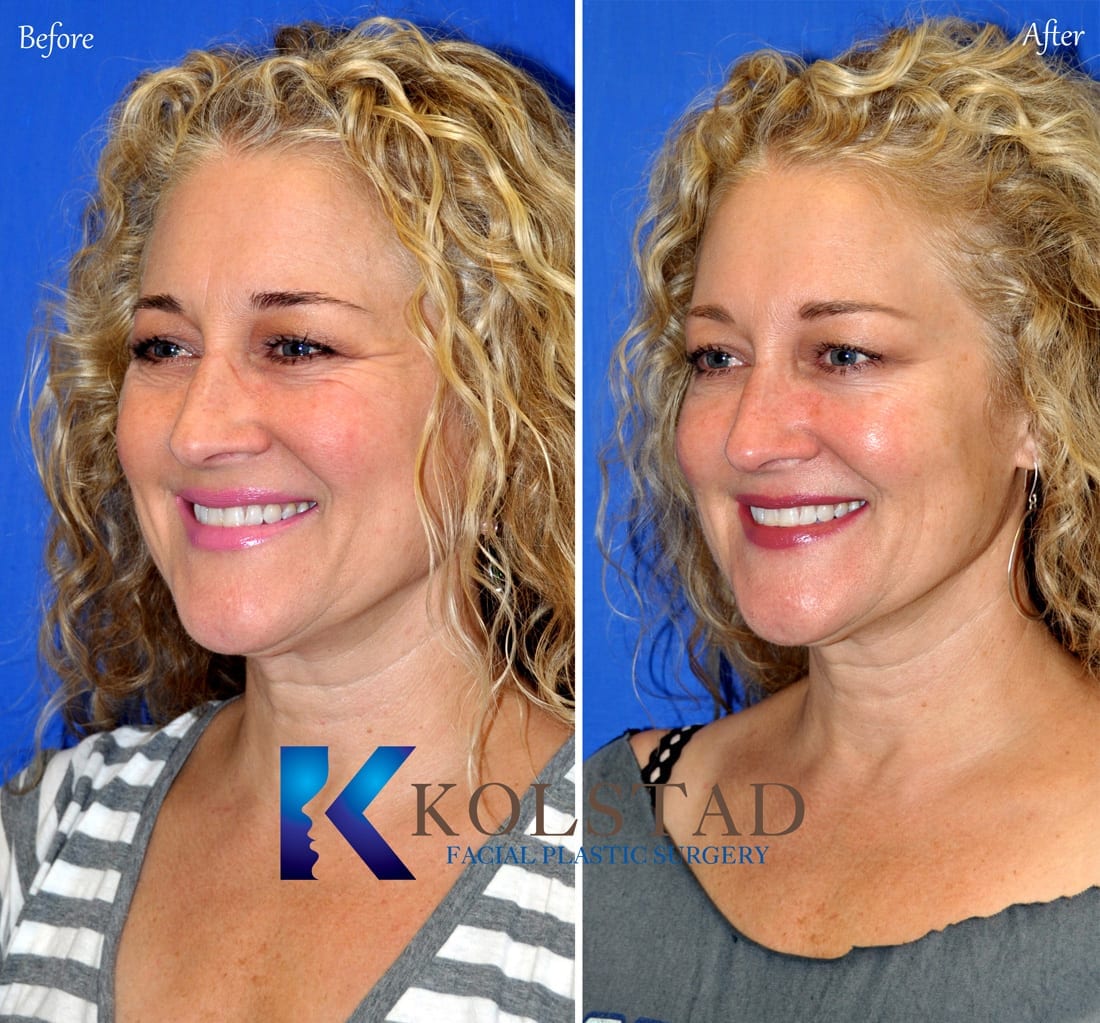 Best Botox Near Me for Eye Wrinkles Before & After Gallery 8 | Dr. Kolstad - San Diego Facial ...