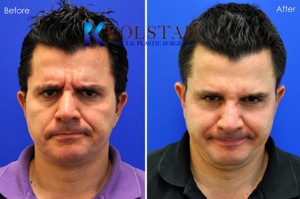 brotox botox juvederm fillers wrinkles best doctor san diego la jolla del mar