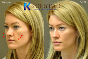 cheek fillers augmentation volume loss juvederm top doctor best injector san diego