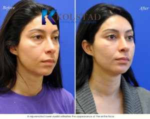 cosmetic nonsurgical eyelid volume correction tear troughs lower eyes restoration top doctor la jolla