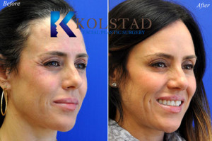 crowsfeet botox treatment cost preventative natural results best injector san diego la jolla