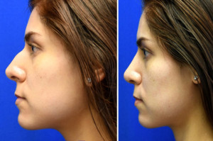 ethnic rhinoplasty san diego