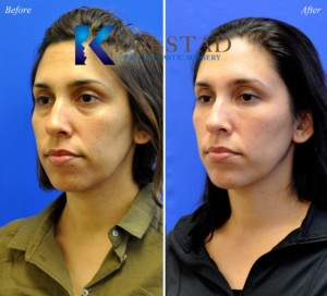facial plastic surgery la jolla del mar carmel valley best injector filler nonsurgical eyelid lift rejuvenation