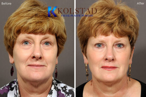Fillers juvederm smile lines sd botox antiaging prevention plastic surgery la jolla
