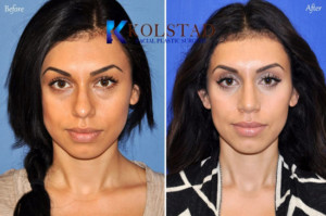 hispanic rhinoplasty san diego