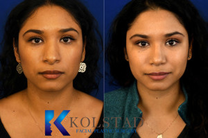 hispanic rhinoplasty san diego