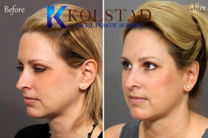 juvederm specials san diego smile lines filler correction natural facial plastic surgery expert