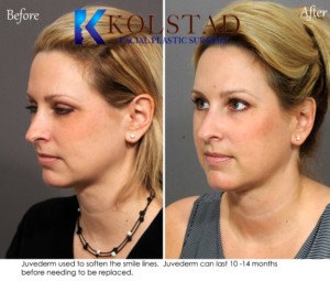 juvederm specials san diego smile lines filler correction natural facial plastic surgery expert