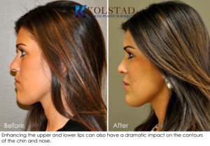 la jolla carmel valley lip augmentation fillers nonsurgical juvederm san diego restylane cost best doctor