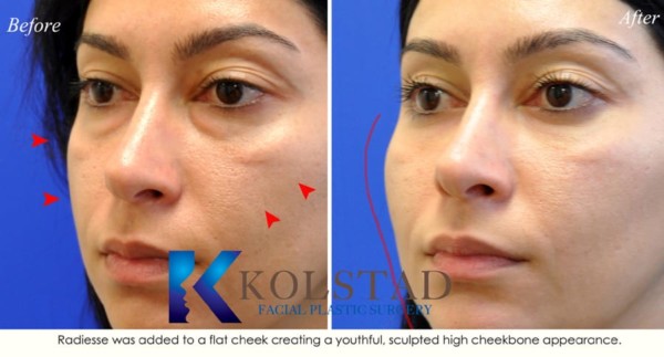 la-jolla-san-diego-under-eye-filler-specialist-volume-correction-cheeks-radiesse-best-injector