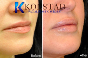 san diego lip filler