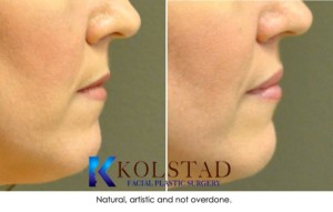 lip fillers san diego la jolla del mar expert injector lip augmentation enhancement injectables